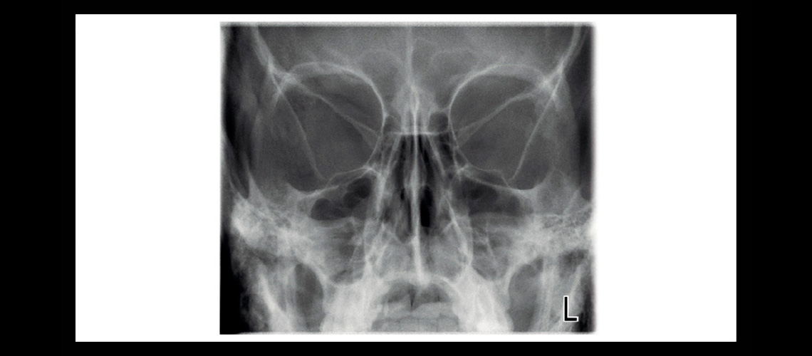 ProMax Clinical Images Sinus